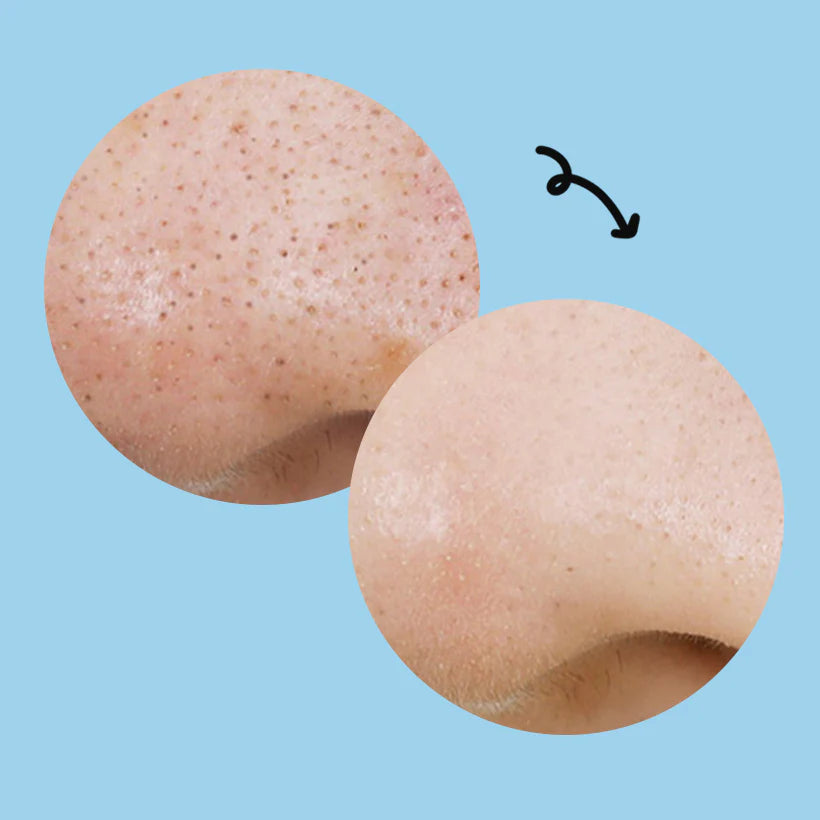 Traitement exfoliant pratique pour une peau nette et sans points noirs.