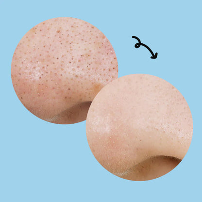 Traitement exfoliant pratique pour une peau nette et sans points noirs.